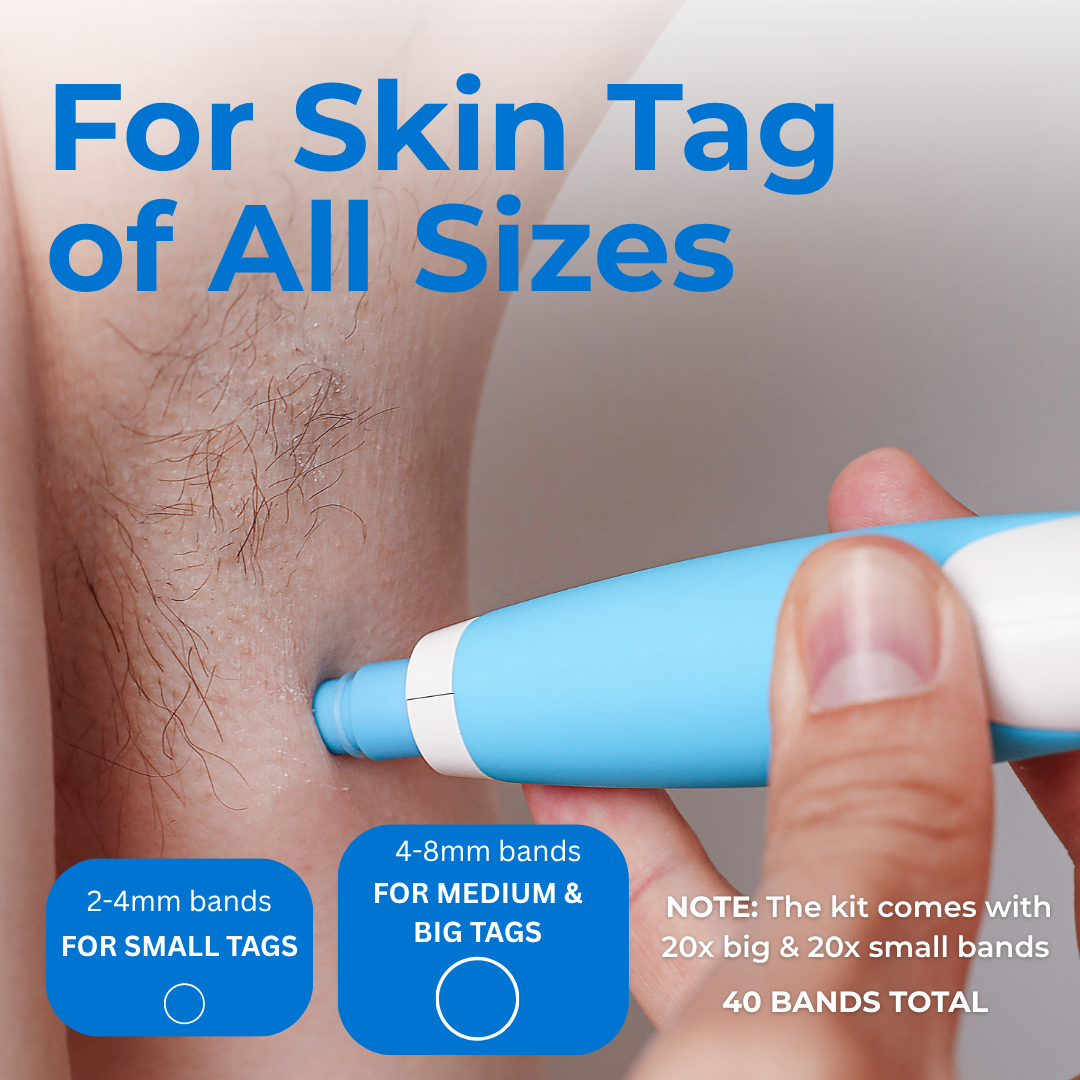 🔥Last Day Sale! 80% OFF!🔥||TagBuddy Kit – For Clearer Looking Skin at Home